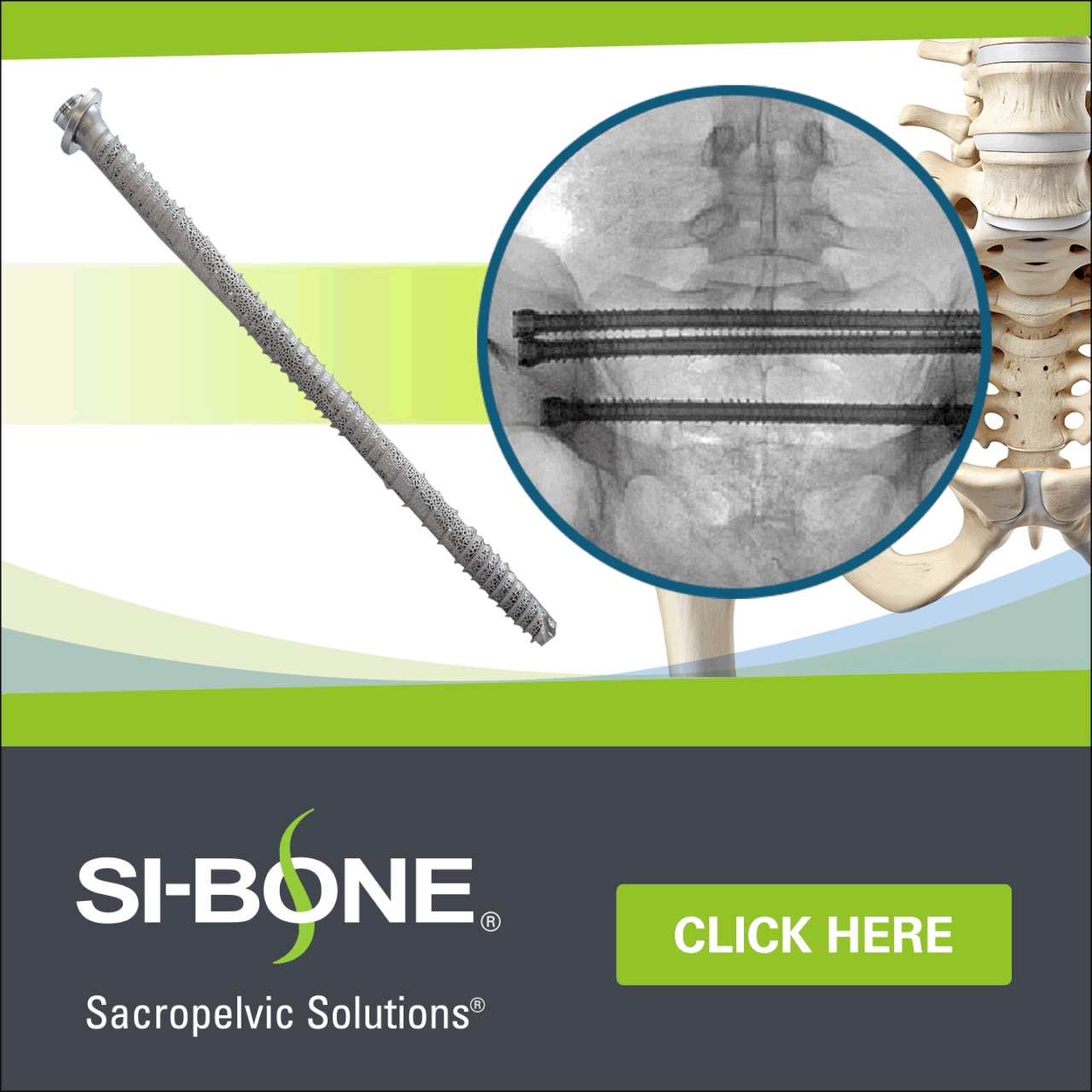 SI-BONE ad