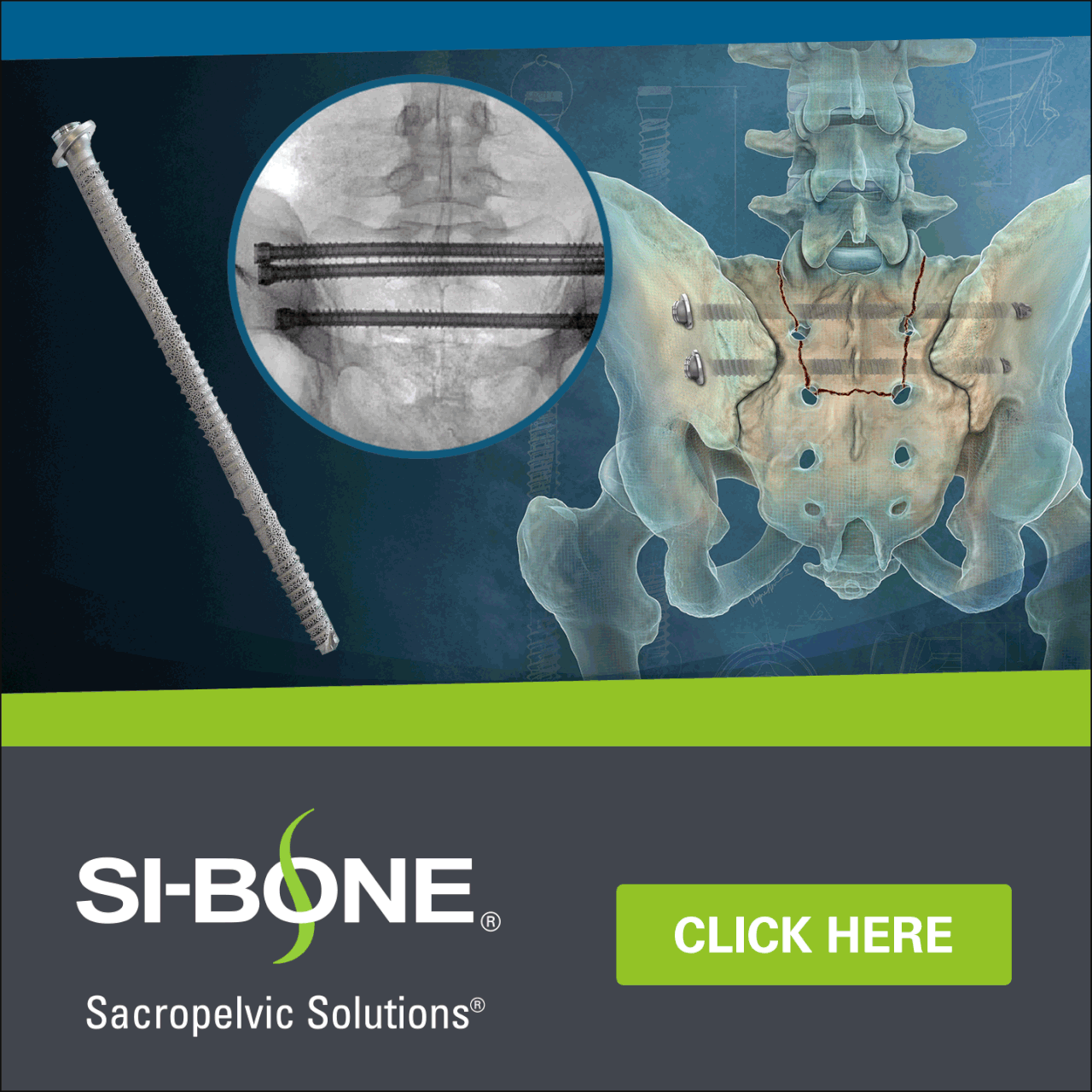 SI-BONE ad